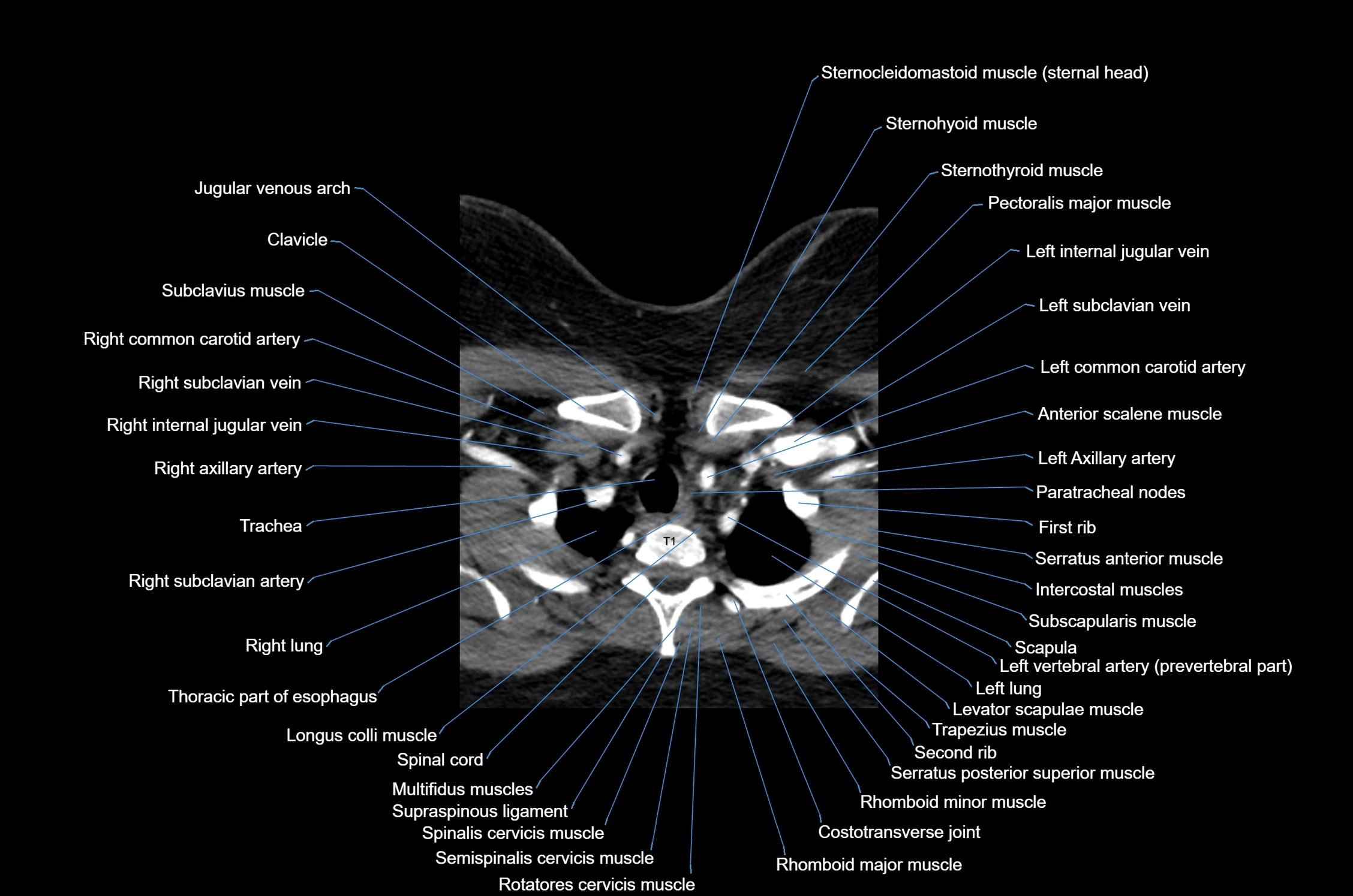 CT Neck axial cross sectional anatomy radiology image-img-00001-00056.webp